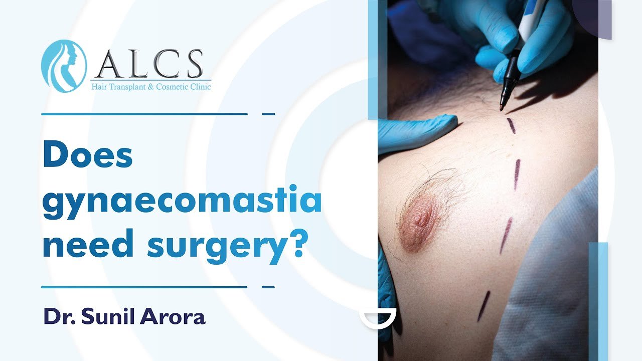 Does Gynaecomastia Need Surgery? | Dr. Sunil Arora
