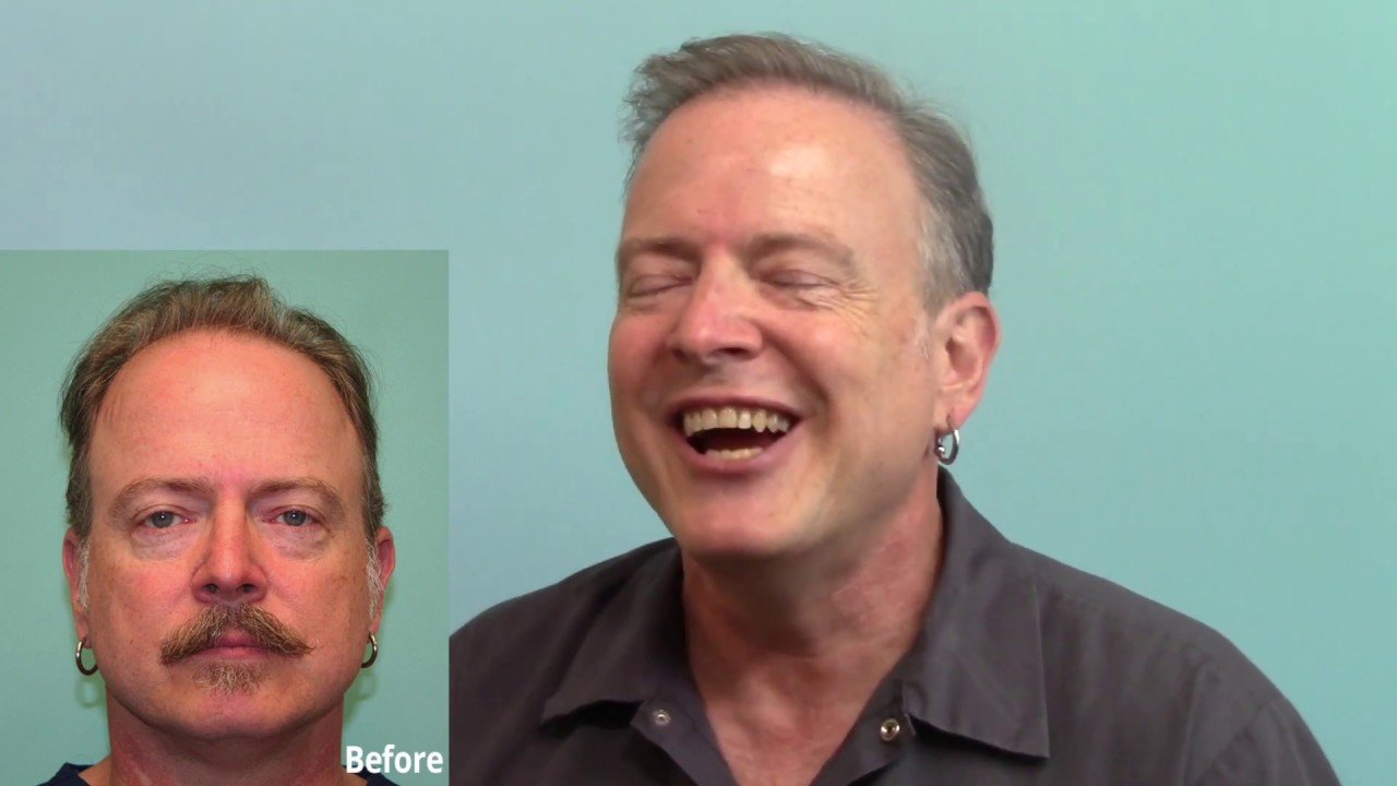 Hair Transplant Patient Profile  - 2 Year, 2 Session Follow Up