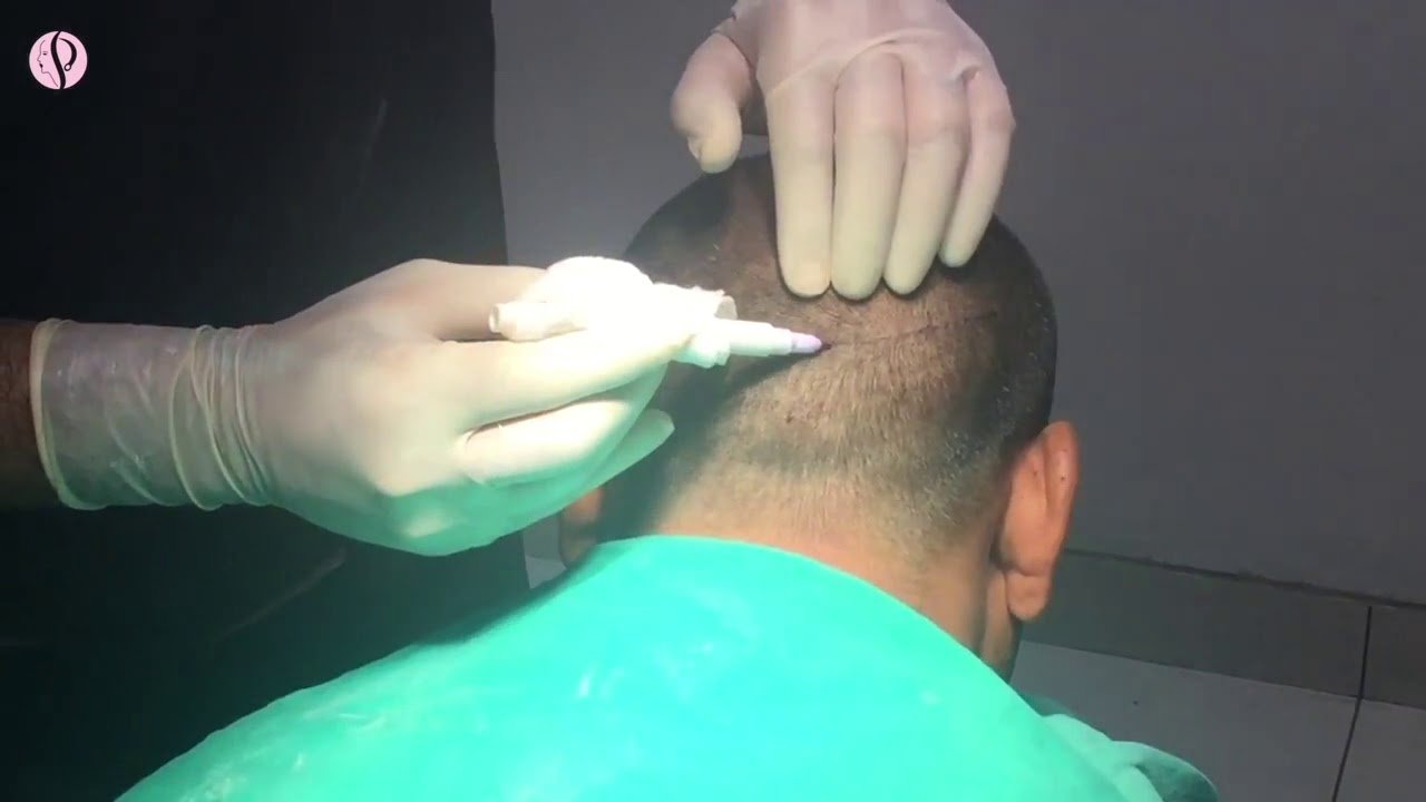 Successful FUT Hair Transplant of 2000 Patients at Profile Studios by Dr. Vikas Gupta
