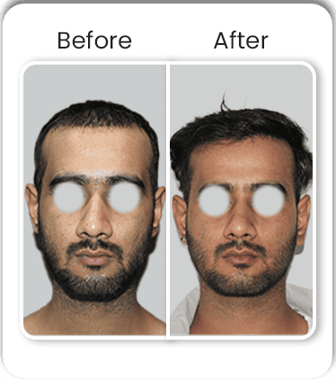 BA5
