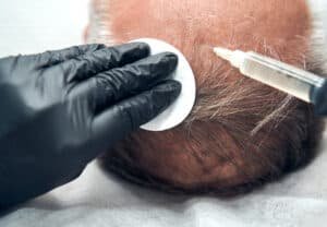 Frontal vs Crown Hair Transplant