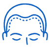Desired hairline design